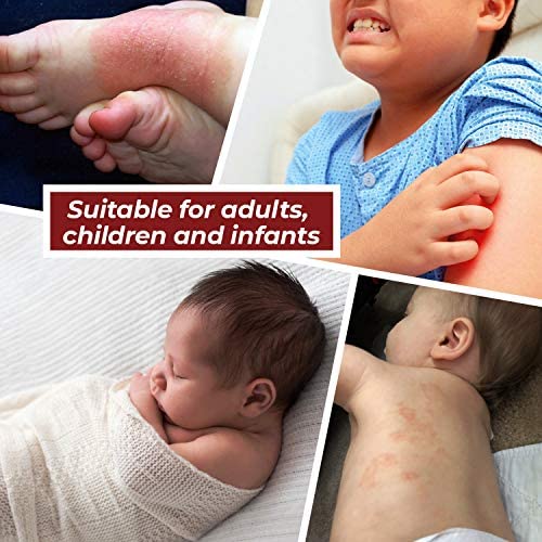 M-Folia M-FOLIA Psoriasis Cream Dual Pack (2 x 100ml) Save Over 10% A Rich, Non-Greasy Skin Cream Specially Formulated to Help Alleviate The Symptoms of Psoriasis, Eczema & Related Dry Skin Conditions