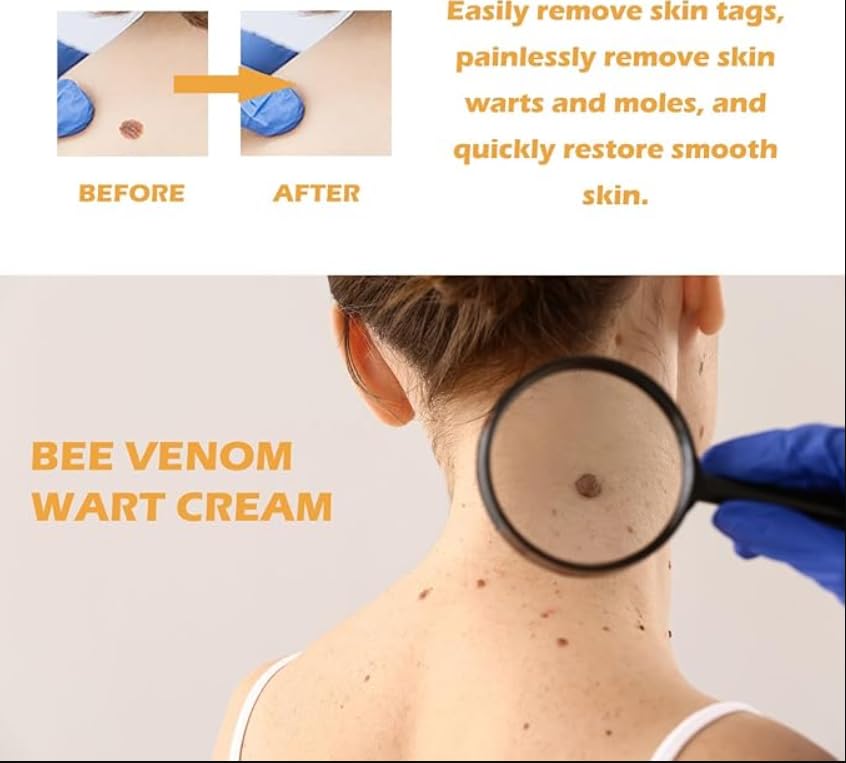 Generic Wree Bee Venom Wart and Tag Remover,Wree Bee Venom Wart and Tag Remover Cream,Wree Bee Venom (1)