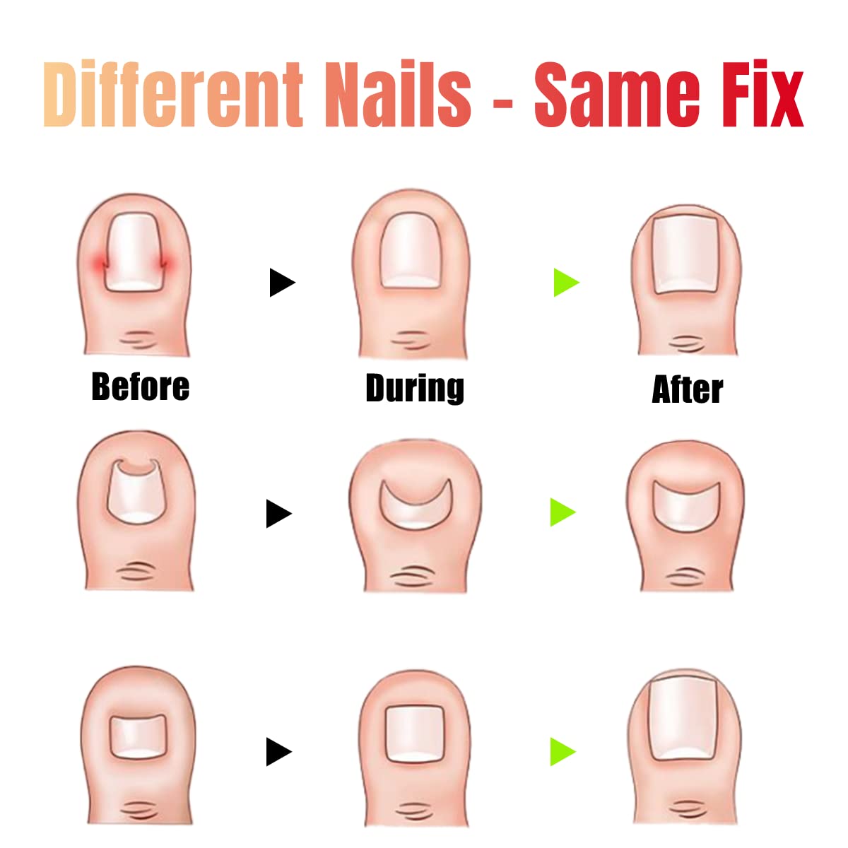 Jinbaetad Ingrown Toenail Correction Treatment Kit with 12 Pcs Ingrown Toenail Correction Pad Recover Clips Ingrown Toenail Corrector Straightener Strips for Women Men's Nail Treatment Pedicure Tool (4 Pcs Set)