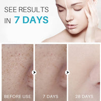 Dark Spot Remover For Face, Hyperpigmentation Treatment, Dark Spot Serum, Melasma treatment for face, Blemish spot treatment, Freckle Remover for Sun Spots, Acne Scars, Melasma for Men & Women, 30g