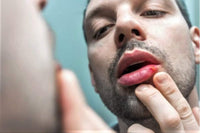 Cold Sore Lip Oil - Famed For Cold Sore Relief Natural Herbal Treatment Vegan