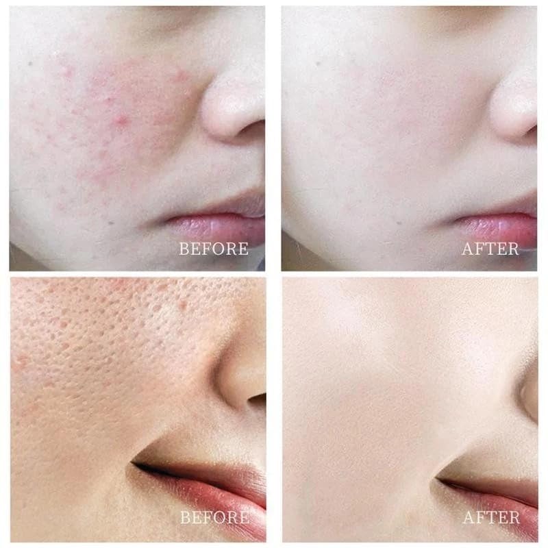 Salicylic Acid Concentrate Super Strong 2% - Acne Spot Treatment - Professional Skincare Serum