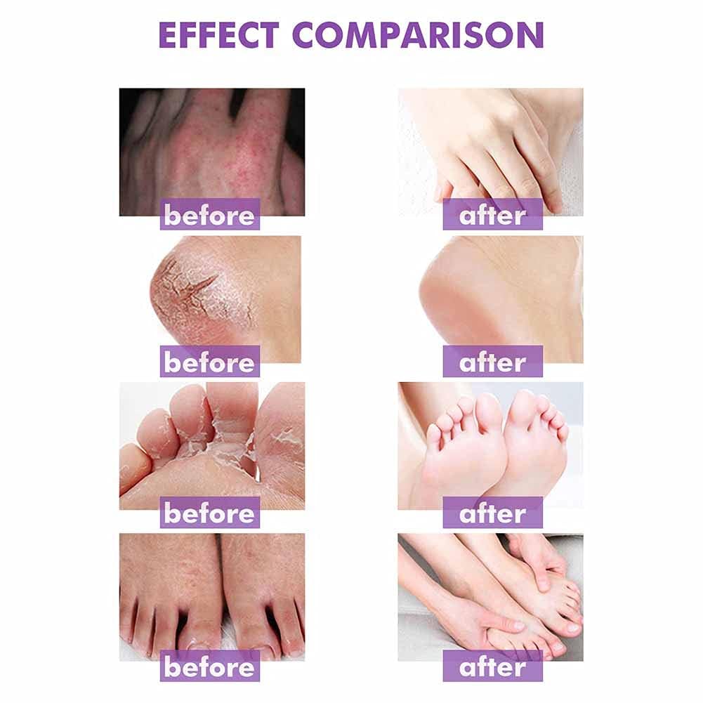 Allbestaye Skin Psoriasis Cream Dermatitis And Eczema Eczema Ointment Treat Dry, Itchy And Sensitive Skin, Face And Body Care Skin Redness And Rash