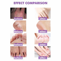 Allbestaye Skin Psoriasis Cream Dermatitis And Eczema Eczema Ointment Treat Dry, Itchy And Sensitive Skin, Face And Body Care Skin Redness And Rash