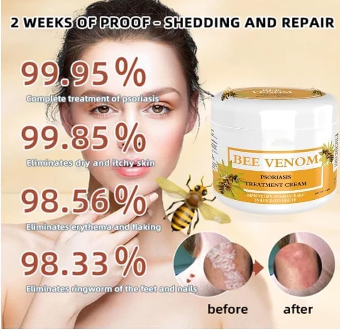 Generic 2PCS 30g Bee Venom Psoriasis Cream, Cvreoz Bee Venom Psoriasis Cream, New Zealand Bee Venom Cream, Fast-Acting Relief Bee Venom Cream Psoriasis Treatment Cream, Soothing Psoriasis Cream(30g*2pcs)