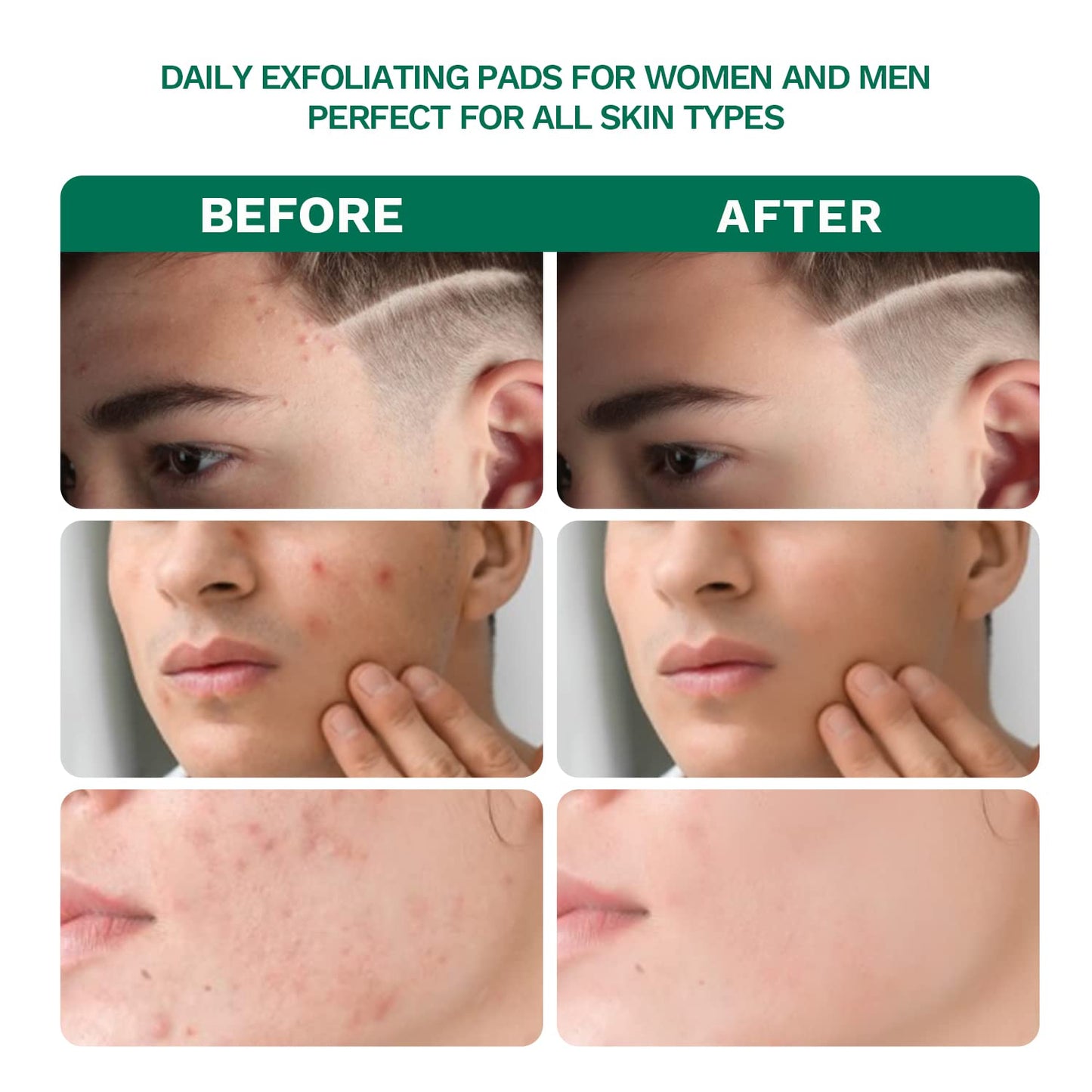 ANAiRUi Salicylic Acid Pads, Exfoliating Face Pads with Witch Hazel, Vitamins B5 & E, Resurfacing Facial Pads for Cleansing Breakouts & Blackheads, Acne & Blemishes, 80 Pads