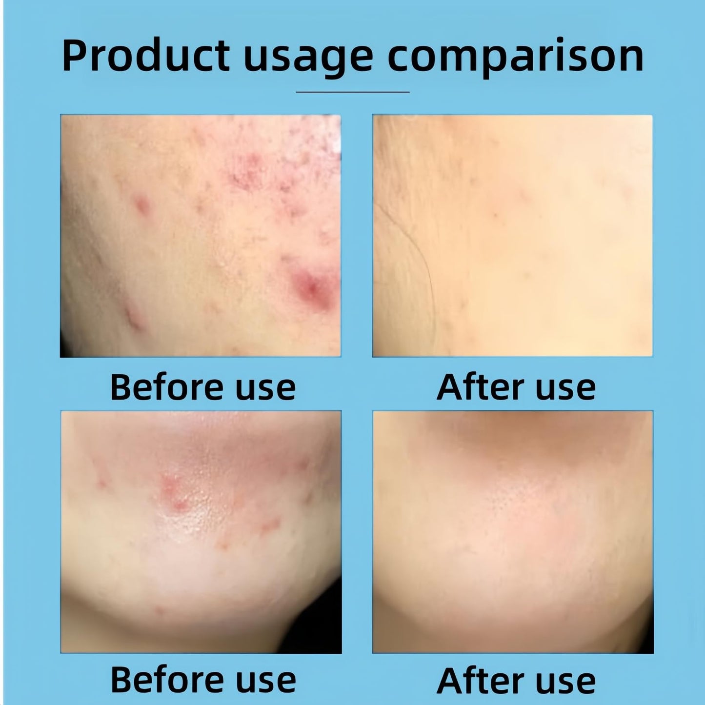 Xunzhi Acne Control Cream for Face,Acne Treatment Gel,A-cne Treatment,A-cne Face Cream,Ac-ne Gel Fast Absorbing Spot T-reatment,Anti Ac-ne F-ace C-ream,Acn-e C-ream for F-ace,Fa-ce Acn-e T-reatment