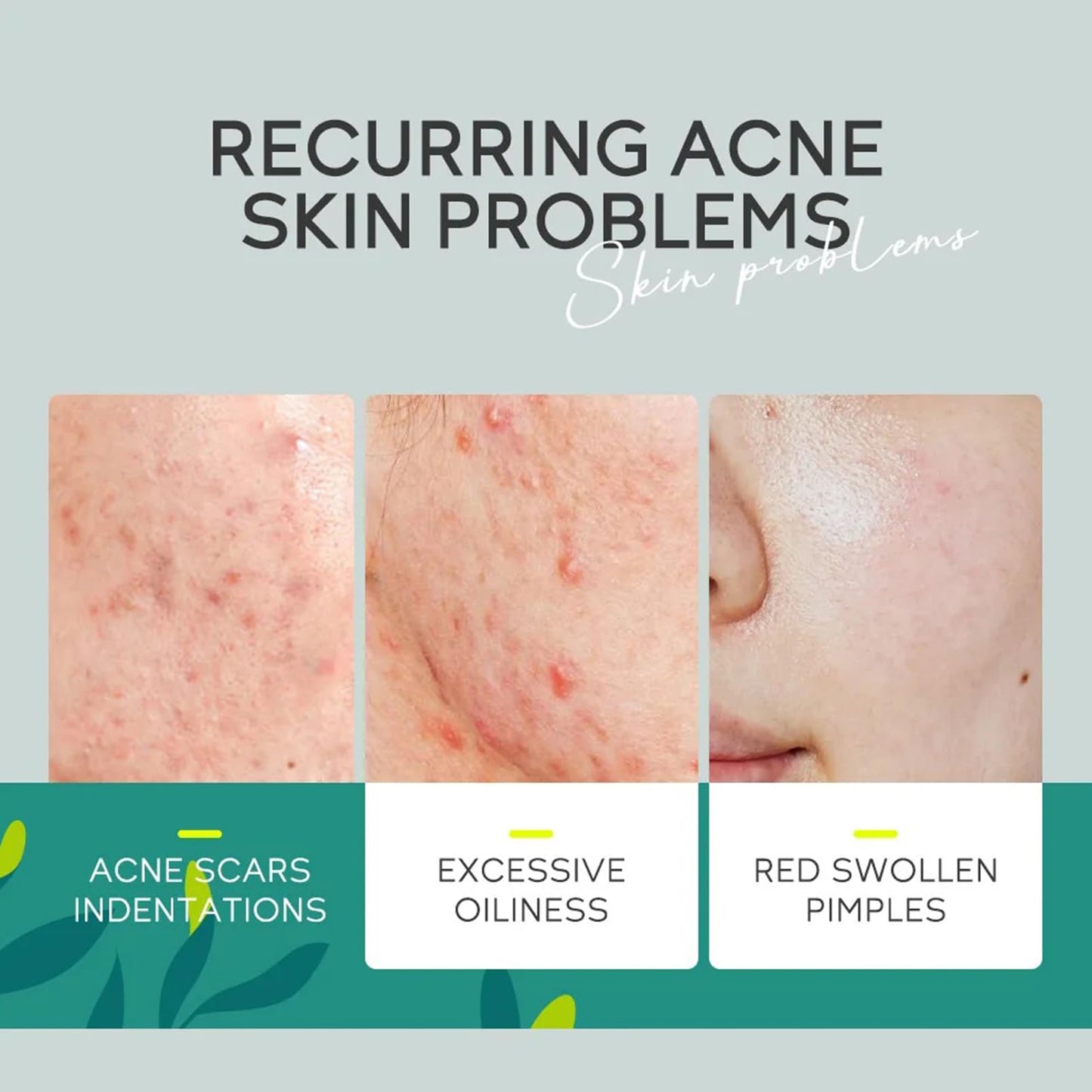 Anti Acne Face Cream, Tea Tree Face Ance Gel, Spot Cream for Acne Treatment and Spot Treatment Shrink Pores, Acne Scars Recovery,Control Sebum Secretion,Relieves Inflammation Redness & Anti-Bacterial