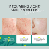 Anti Acne Face Cream, Tea Tree Face Ance Gel, Spot Cream for Acne Treatment and Spot Treatment Shrink Pores, Acne Scars Recovery,Control Sebum Secretion,Relieves Inflammation Redness & Anti-Bacterial