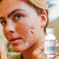 Eveloveu Anti-Acne Serum & Drying Lotion – Fast-Acting Acne Treatment to Dry Out Blemishes, Reduce Pimples & Redness. Gentle Acnecide Face Lotion for Teenage Girls, Women & Men – Clear, Healthy Skin Care