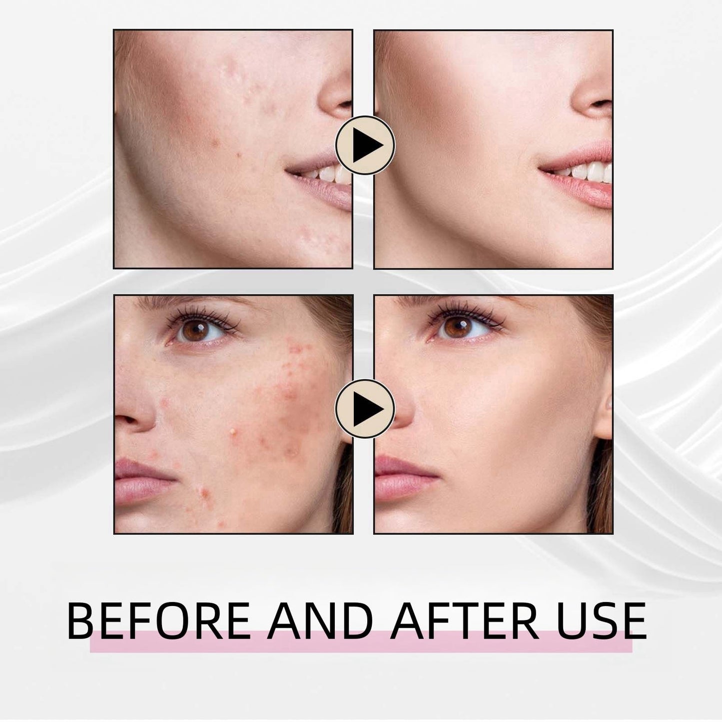 Azelaic Acid 15% Acne Tratment Gel,Azelaic Acid Serum Cream with Niacinamide & Vitamin C,Anti Acne Gel for Spot Prone Skin,Face Serum for Women,Hydrating Serum,Moisturiser Face,Serums Skincare