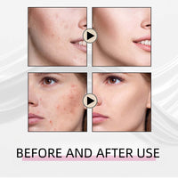 Azelaic Acid 15% Acne Tratment Gel,Azelaic Acid Serum Cream with Niacinamide & Vitamin C,Anti Acne Gel for Spot Prone Skin,Face Serum for Women,Hydrating Serum,Moisturiser Face,Serums Skincare