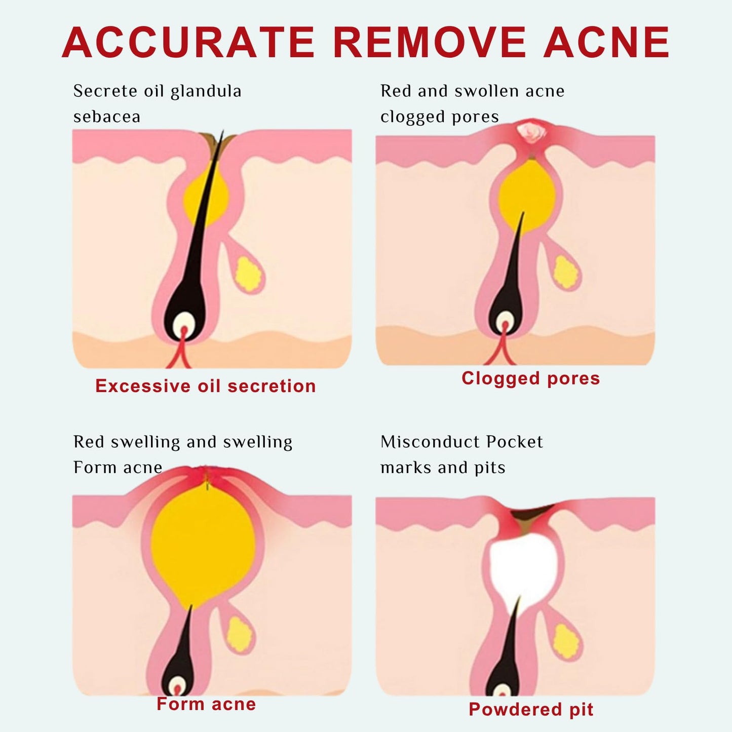Acne Treatment Cream – Fast Acting Spot Treatment for Face - Blemish Control Cleanser Reduces Pimples, Blackheads & Blemishes - Gentle Skin Care for Oily & Acne-Prone Skin, 40g (2 Value Packs)