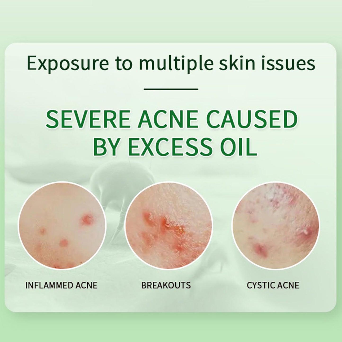 Anti Acne Face Cream,Gentle Acne Cream for Acne Prone Skin,Anti Acne Removal Cream with Plant Extract,Moisturiser Face Cream for Acne Mark,Fade Acne Mark & Calm Acne Redness,Scar Removal Cream