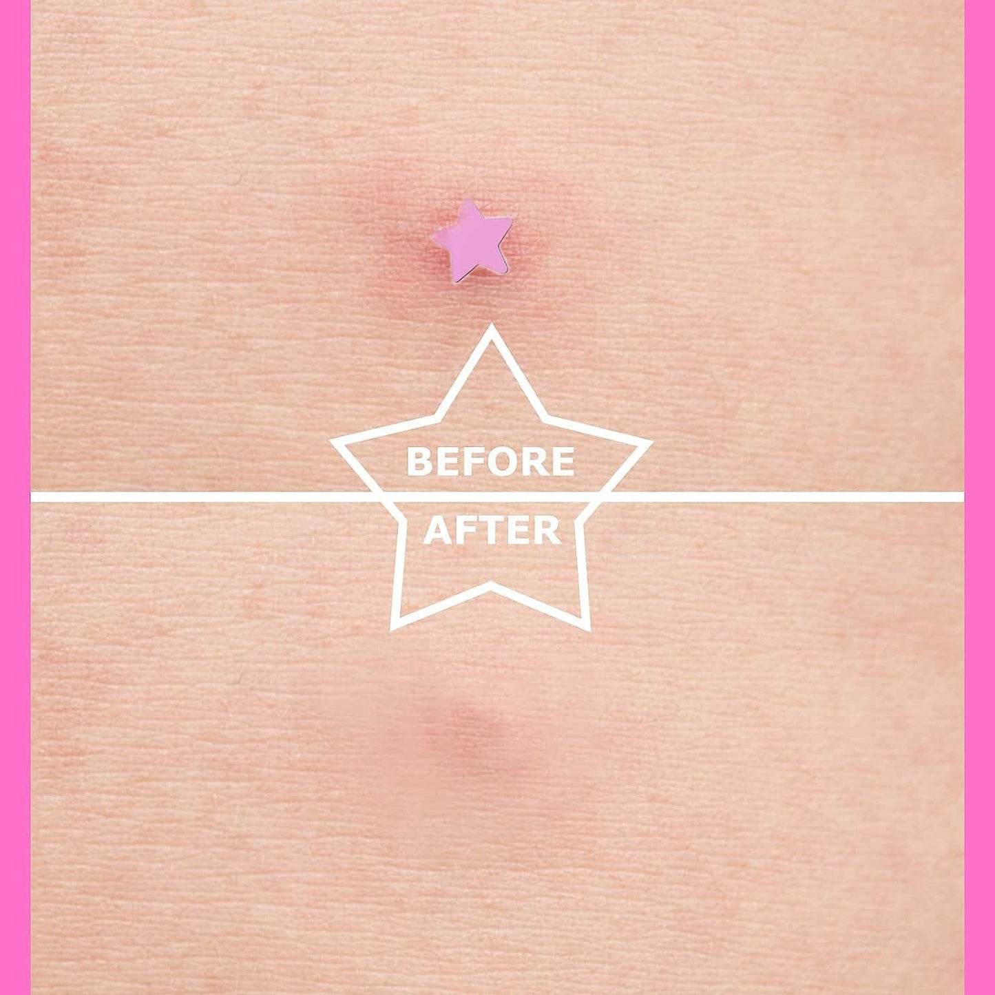 AUSLKA Star Pimple Patches -156 Patches - Hydrocolloid Spot Dots, Blemishes Patch - Pimple Stickers, Patches To Cover Facial Blemishes