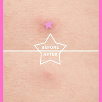AUSLKA Star Pimple Patches -156 Patches - Hydrocolloid Spot Dots, Blemishes Patch - Pimple Stickers, Patches To Cover Facial Blemishes