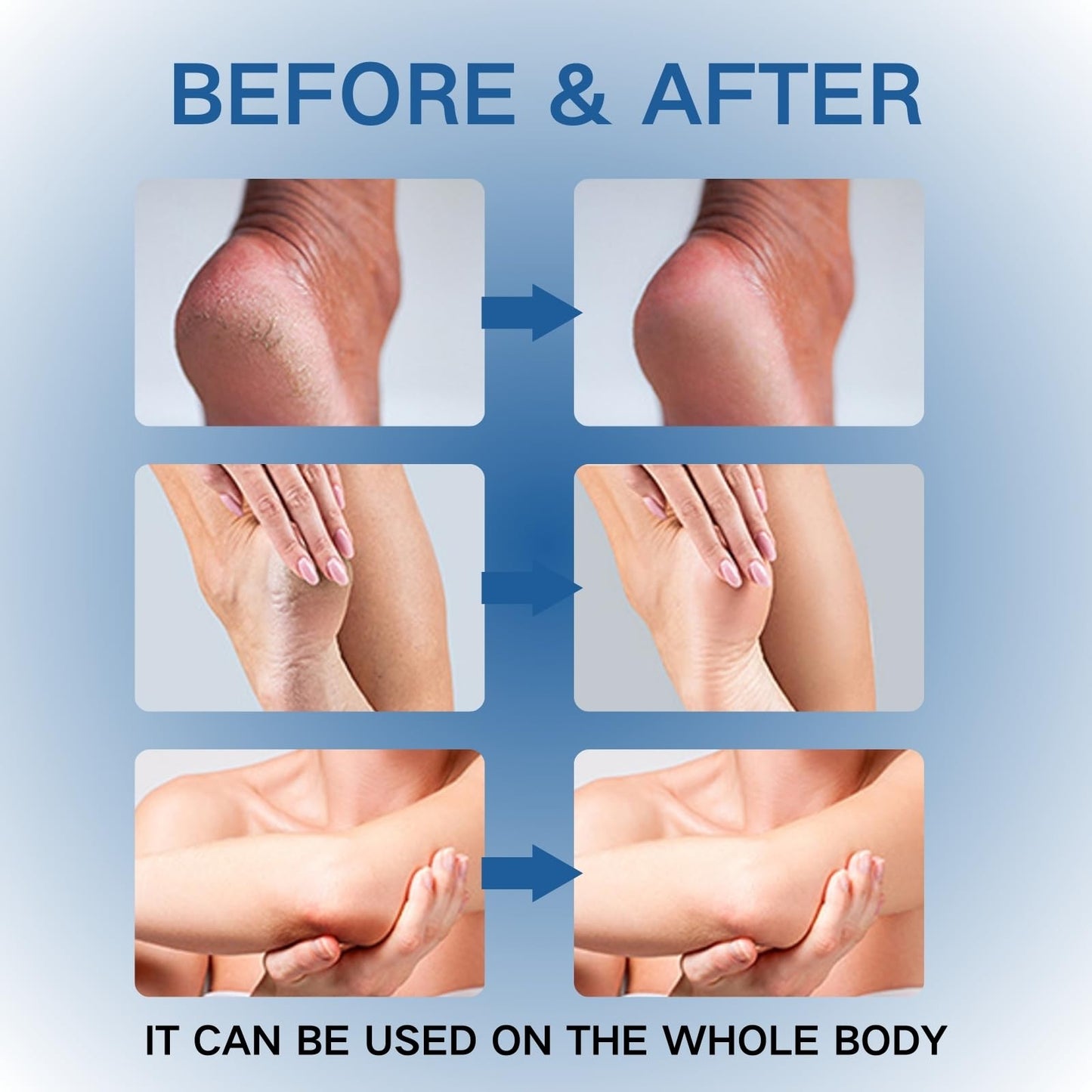 Urea Foot Cream 42% - Foot Cream - Foot Cream for Cracked Heels and Dry Skin - Cracked Heel Repair Cream for Hand and Feet - 42% Urea Cream & 2% Salicylic Acid for Callus Remover & Nourishes Soften