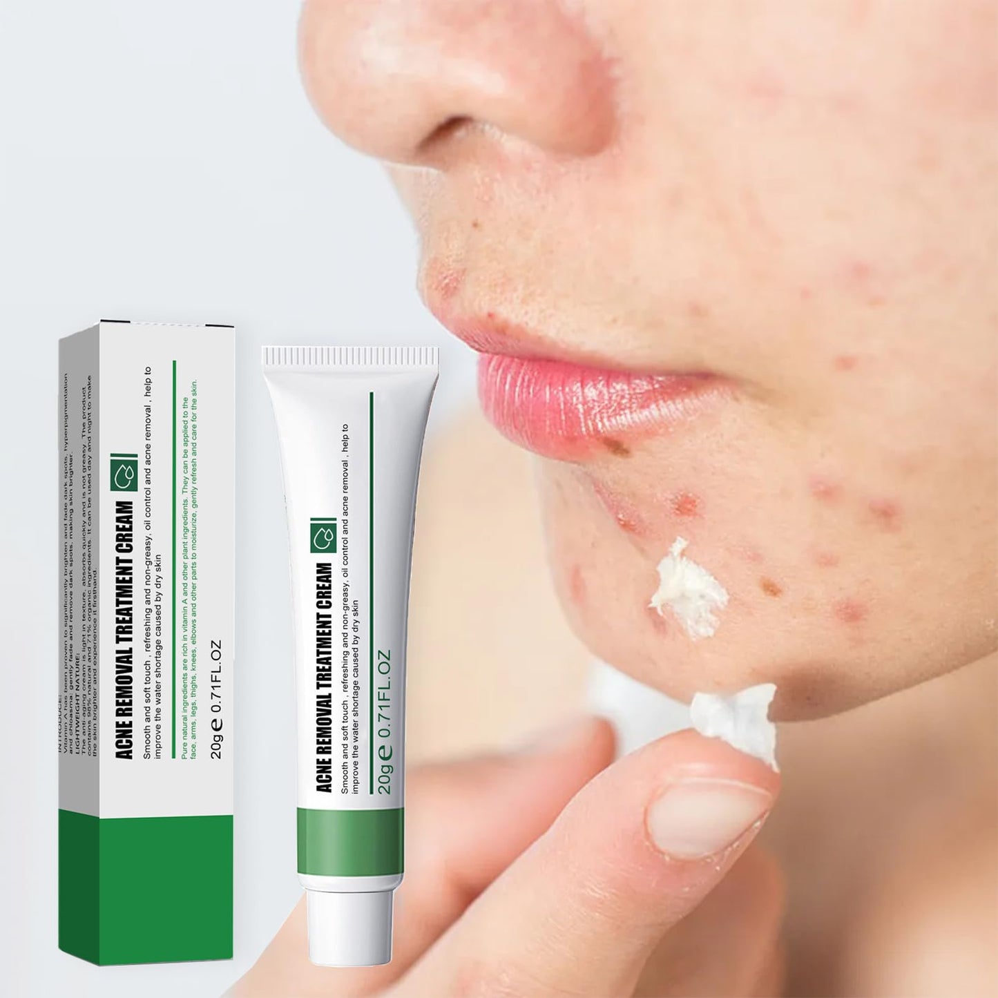 Anti Acne Face Cream, Spot Cream for Acne Treatment and Spot Treatment with Nicotinamide, Sodium Hyaluronate, Aloe, for Blackheads and Acne Prone Skin, Reduces Spot Size, Redness and Inflammation