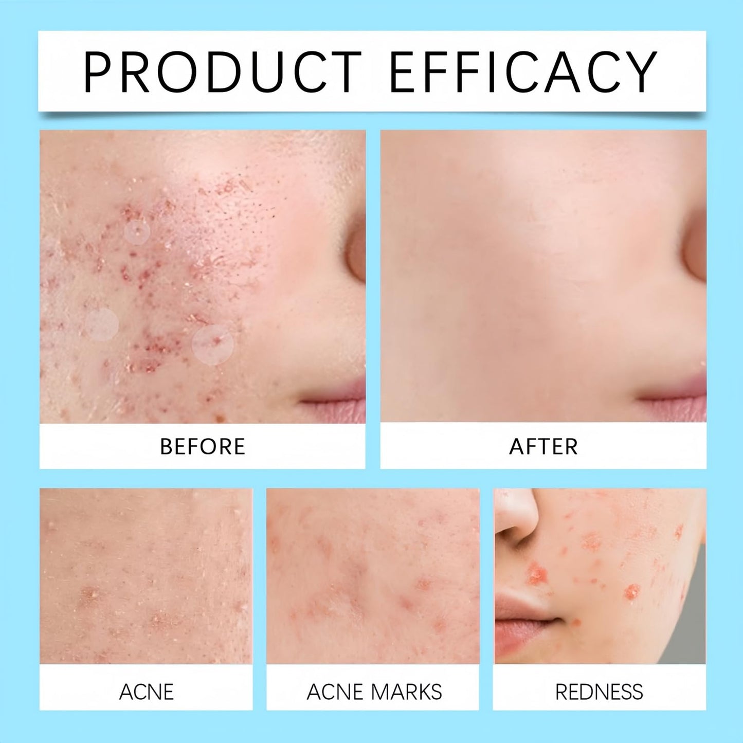 Retinol Gel,Acne Treatment Gel,Acne Control Cream for Face,Anti Acne Gel for Spot Prone Skin,Retinol Moisturizer Cream,Brightens Skin and Improves Elasticity,Face for Pimple Reduce,Without Over Drying