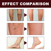 Oumun Care Cream for Legs,Vari/cose Ve/ins Cream,Improve Blood Circulation,Vari/cose Ve/ins Treatment for Legs,Strawberry Skin Treatment,Urea Cre/am Kerat/osis Pila/ris,Cre/am for Dry Skin on Le/gs