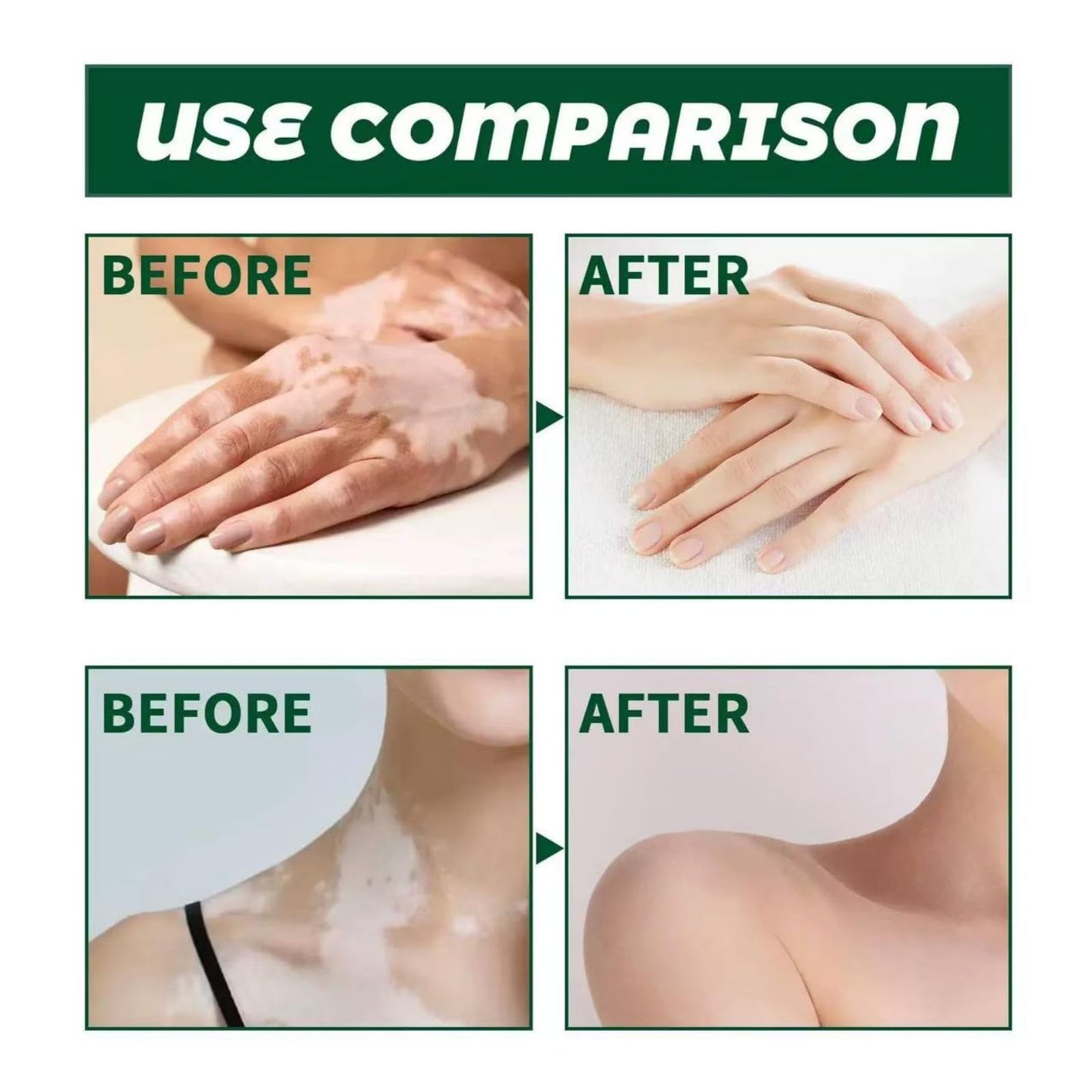 Yoowan Treatment Cream,Freckle Removal Cream,Freckle Remover,Skin Barrier Repair Cr-Eam,Effectively Alleviate The White Blemishes On The Skin,Daily Repair Balm,Deep Moisturizing For Dry Face And Body