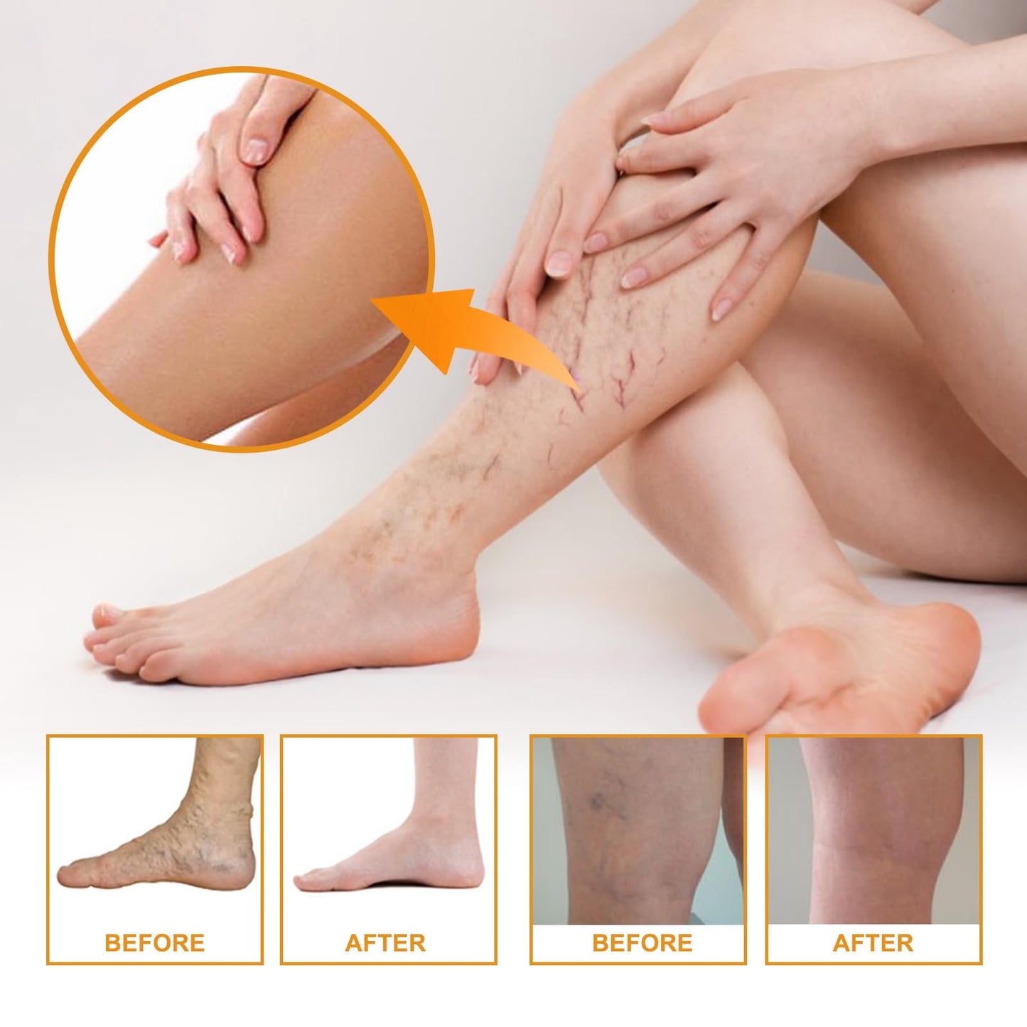 Varic/ose Ve/ins Treatment for Legs,Natural Varic/ose Ve/ins Cream,Varic/ose Ve/ins Treatment Cream,Cream for Varic/ose Ve/ins in Legs,SPI/der V/eins Repair Cream,Varic/ose Ve/ins Relief Cream
