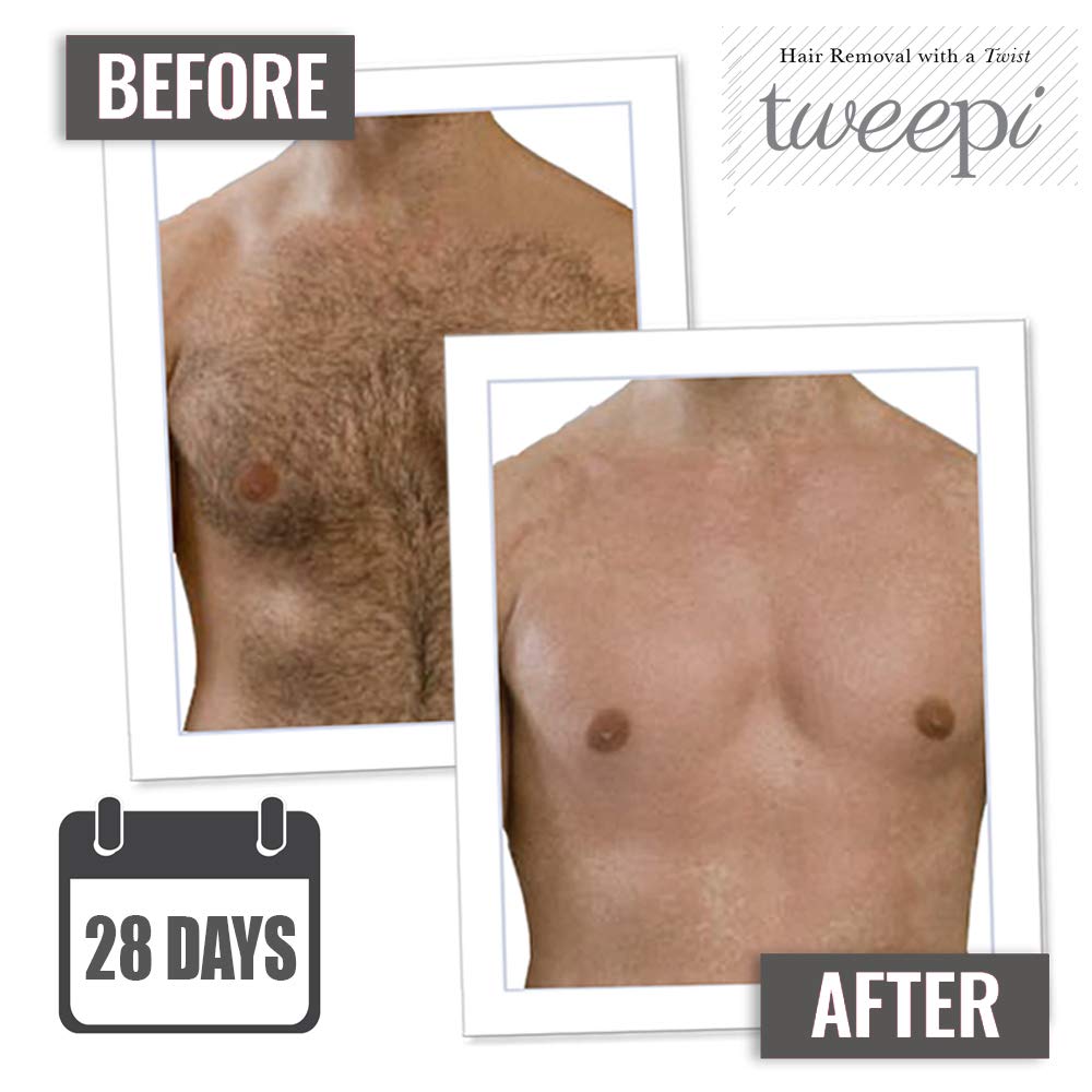 Tweepi Hair Growth Inhibitor Serum Oil- Permanent Body & Face Hair Removal- Modern Day Ant Egg Oil- Paraben Free- MADE IN UK- 50G