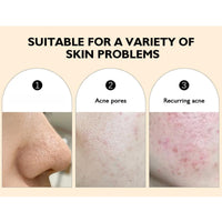 Siyinzu Acid Face Cream,10% Acid Gel For Facial and Skin Care,Ac/id 10% Acne Tratment Ge/l,Anti Acne G/el for Spot Prone Sk/in,Brightening Face S/kin Care Treatment,Dark Spot Serum Cream for Face