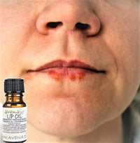 Cold Sore Lip Oil - Famed For Cold Sore Relief Natural Herbal Treatment Vegan