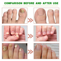 Ginger Nail Essence, 7days Nail Treatment,Hand Oil Damaged Nail Repair And Strengthening Nail Care 3PCS