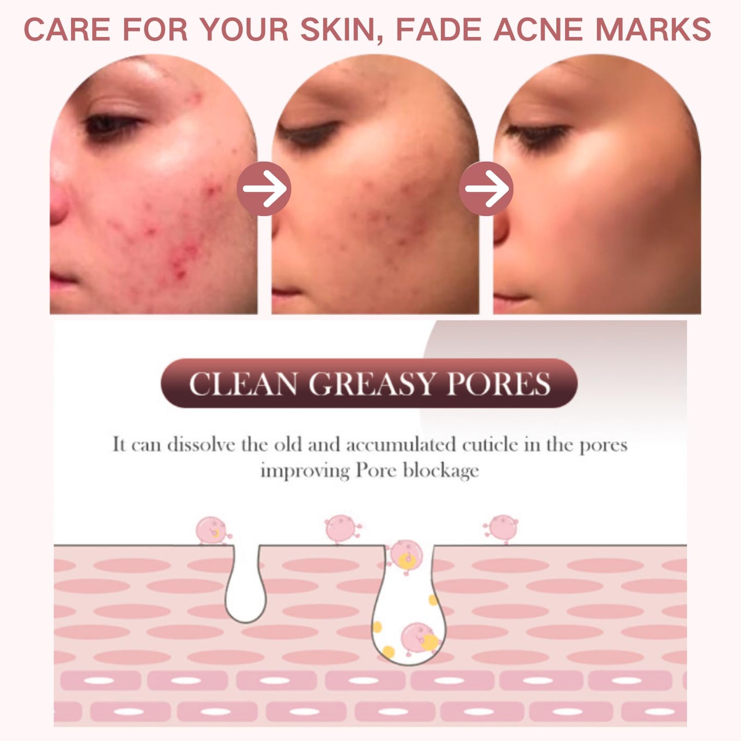ISBEAUSOLS 2pcs Acne Tratment Face Gel 15% Acid - Spot Treatment For Face - Acne Treatment for Spot Prone Skin - Spot Gel for Women,Men,Teenager - Clean Skin,Pimple Reduce,Blackhead Remover