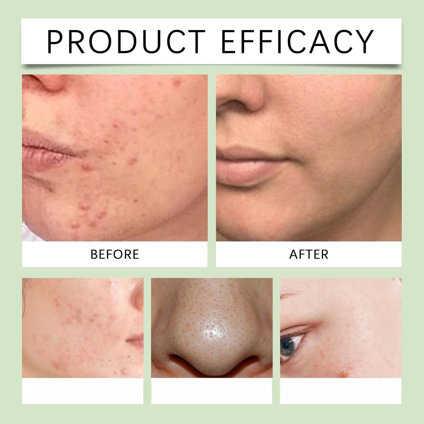 Siyinzu Acid Face Cream,10% Acid Gel For Facial and Skin Care,Ac/id 10% Acne Tratment Ge/l,Anti Acne G/el for Spot Prone Sk/in,Brightening Face S/kin Care Treatment,Dark Spot Serum Cream for Face