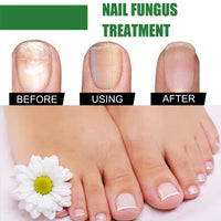 7 Days Nail Fungus Treatment,Ginger Nail Treatment,Fungal Nail Treatment,Toenail Fungus Treatment Extra Strength,Fungal Nail Treatment for Toenails Extra Strong,Nail Repair,Nail Growth Serum,50ml