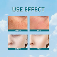 GNAUMORE Freckle Remover Cream,Dark Age Spot Remover,Spot Cream Dark Spot Corrector,Reduce Dark Spots & Soften Skin,Hyperpigmentation Treatment,20g