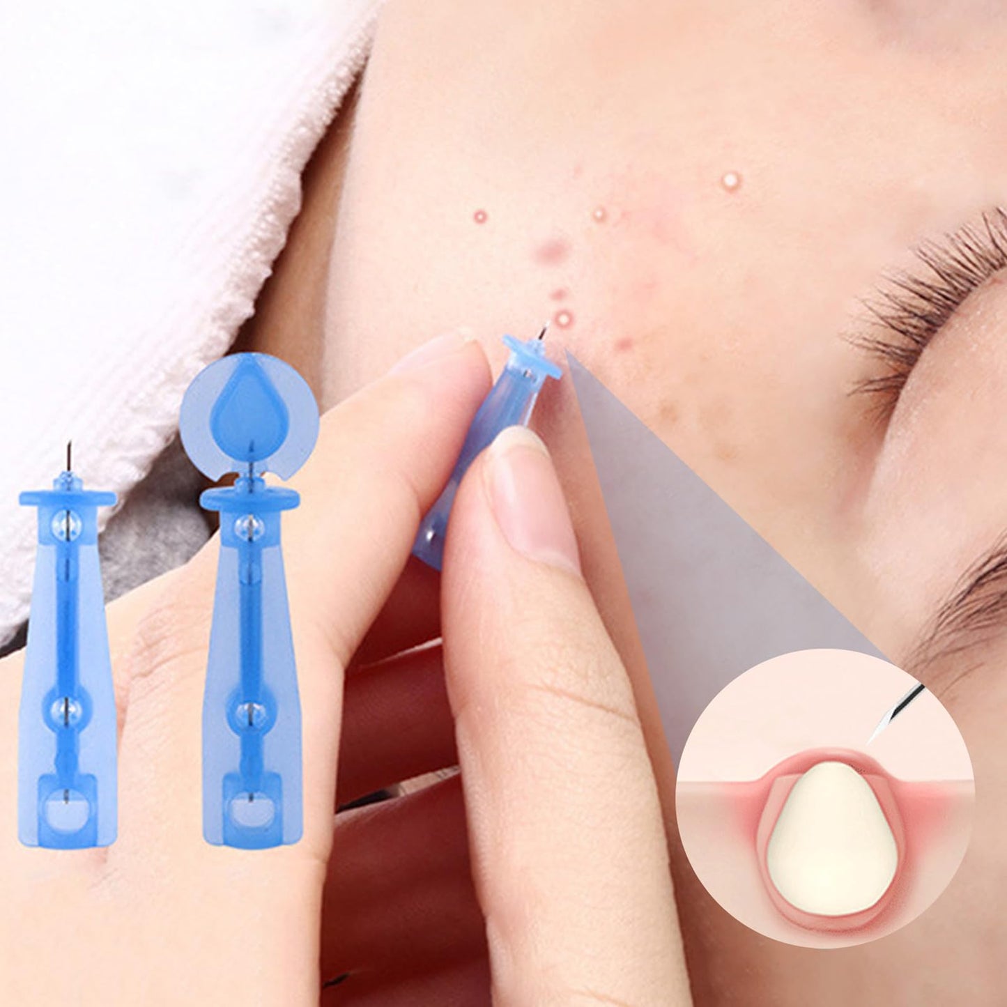 LFWZRY 100pcs Blackhead Blemish Remover with Acne Spot Remover Pin, Disposable Acne Pimple Popper Needle, Pimple Needles, Professional Whitehead Acne Blackheads Remover Tools for Beauty Salon Home