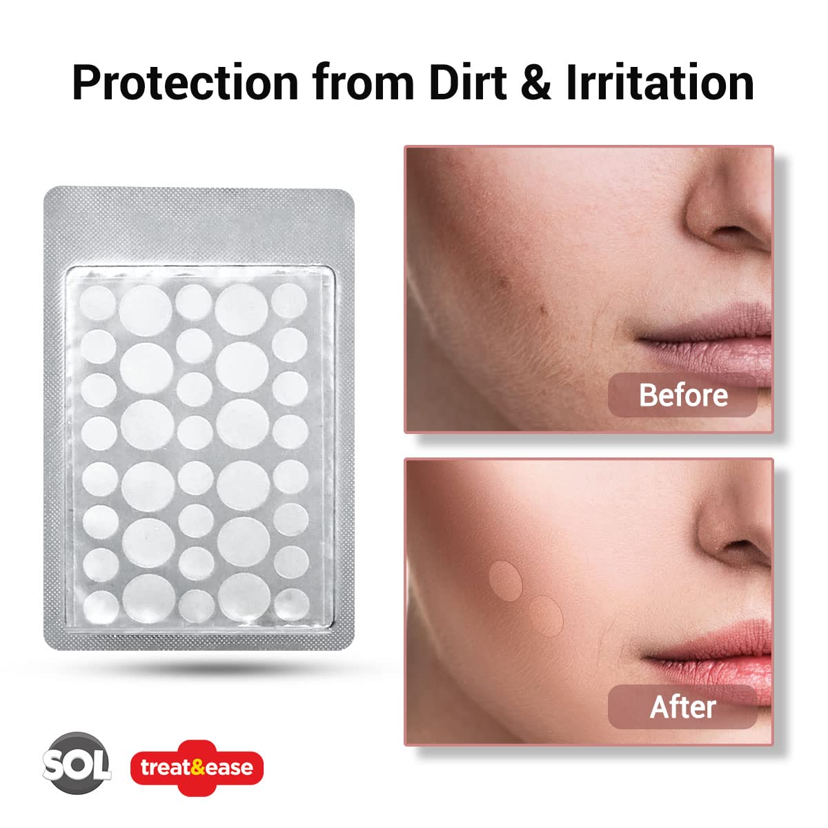 36pk Spot & Cold Sore Patches | 12pcs 8mm & 24pcs 12mm Skin Care Pimple Patches | Acne Patch Hydrocolloid Patches | Face Care Spot Patches | Pimple Patch Acne Patches Hydrocolloid Patch + SOL Sticker