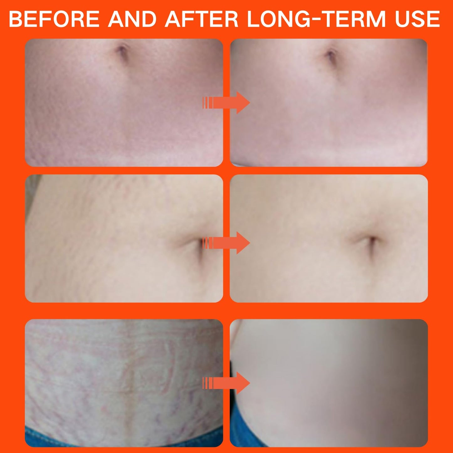 ISBEAUSOLS Scar & Stretch Mark Removal Oil – Collagen Boosting & Firming Body Oil for Women, Skin Regenerate Massage Oil, Moisturising Skincare Oil Improves Skin Texture & Elasticity 125ml