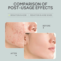 Acne Spot Treatment Cream, Aloe Vera Acne Removal Gel, Spot Cream Targets Acne, Pimples, Blemishes and Blackhead Removal, Acne Cream Anti-Acne, Oil-control, Remove pimples, Shrink Pores