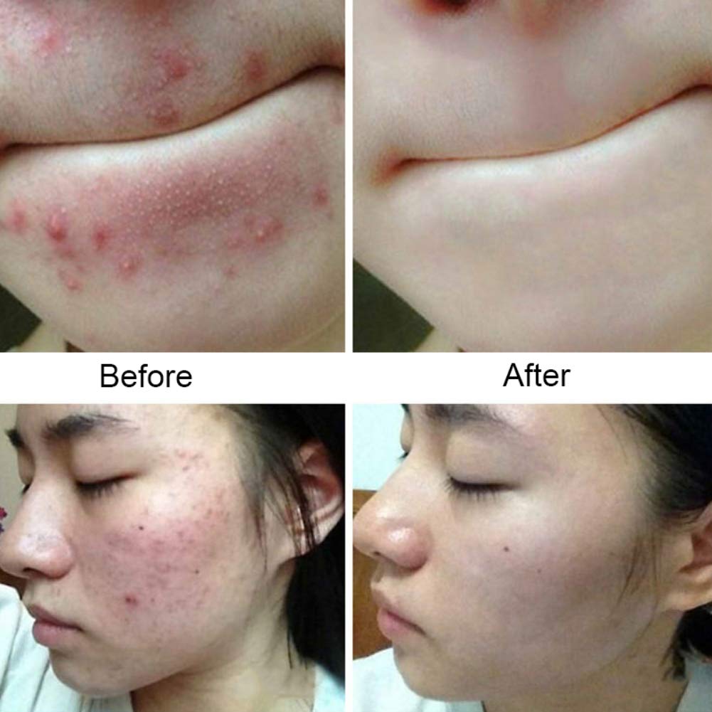 Allbestaye Mite Remove Soap Facial Soap Rich In Sea Salt Quickly Mites Repair Nourish Cleansing One Piece