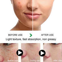 50g Salicylic Acid Acne Cream,3% BHA Spot Cream for Acne,Anti Redness Crea-m for Face,Ac-ne Scar Removal Cre-am,Pimple Cre-am for Redness,Moisturizing Face Cr-eam for Women,Dark Spot Remover for F-ace
