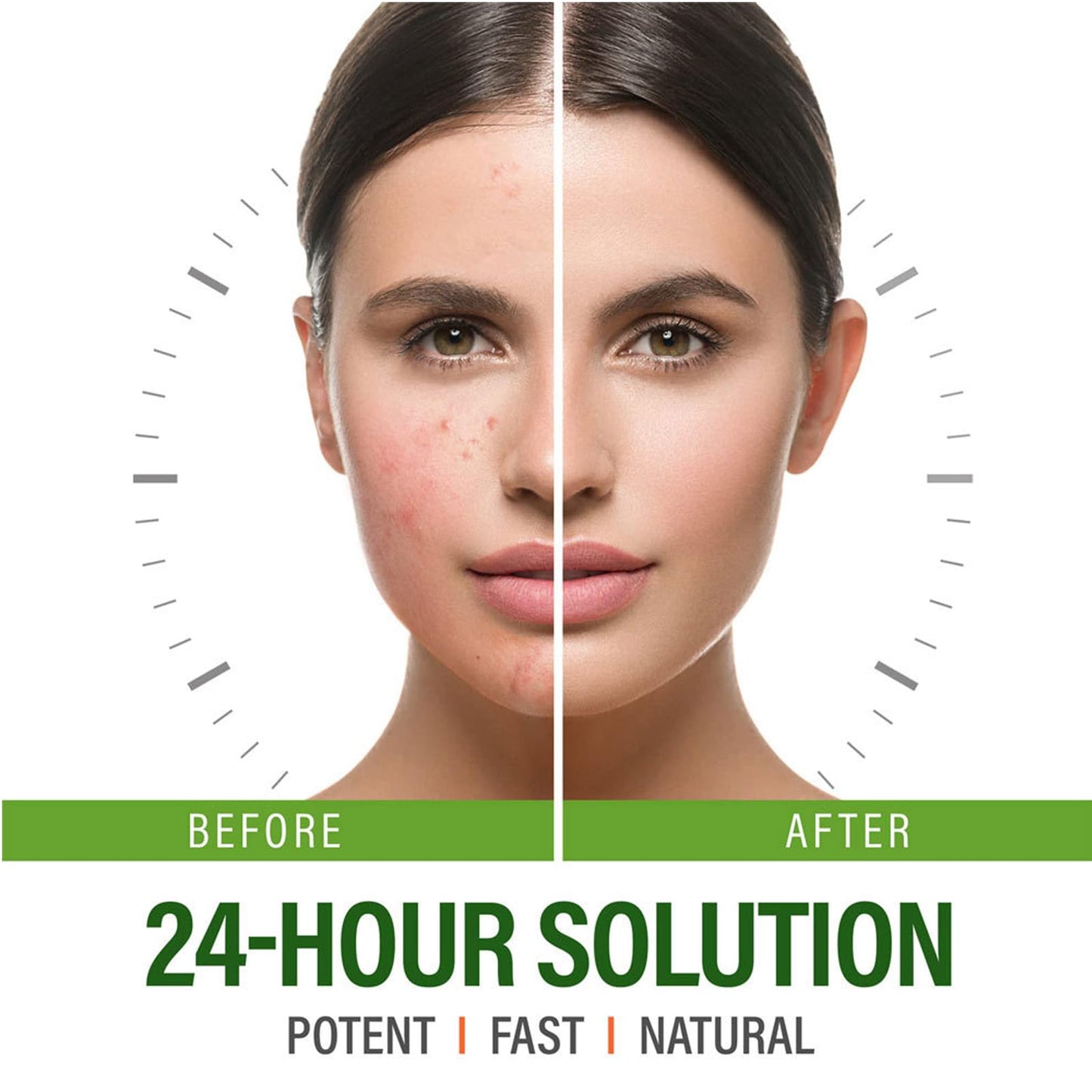 QEUTKEZS Herbal Acne Removing Cream,Professionally Remove Acne Marks,Gently Moisturize,Refreshing & Not Greasy,Improving Sensitive Skin Prone to Acne,Acne Scar Cream & Pimple Remover For All Skin Types