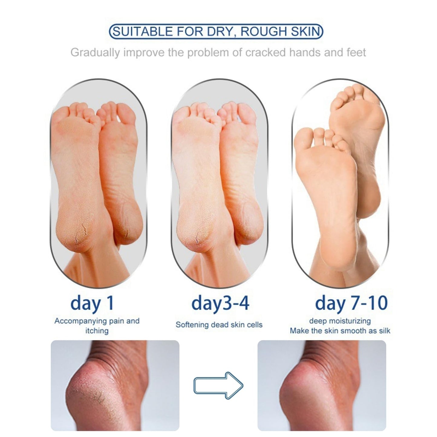 ISBEAUSOLS Urea Cream 60 Percent for Feet - Urea Foot Cream - Foot Cream for Cracked Heels and Dry Skin - Cracked Heel Repair Cream - Skin Care Hands & Feet - Foot Moisturiser -1PCS