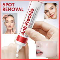 MINSHZEE Freckle Removal Cream - Removes facial dark spots, Dark Spot Remover with Niacinamide and Vitamin C, Improves dull skin (2 piece)