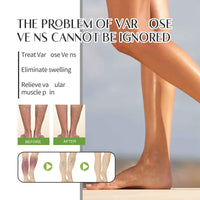 Oumun Care Cream for Legs,Vari/cose Ve/ins Cream,Improve Blood Circulation,Vari/cose Ve/ins Treatment for Legs,Strawberry Skin Treatment,Urea Cre/am Kerat/osis Pila/ris,Cre/am for Dry Skin on Le/gs