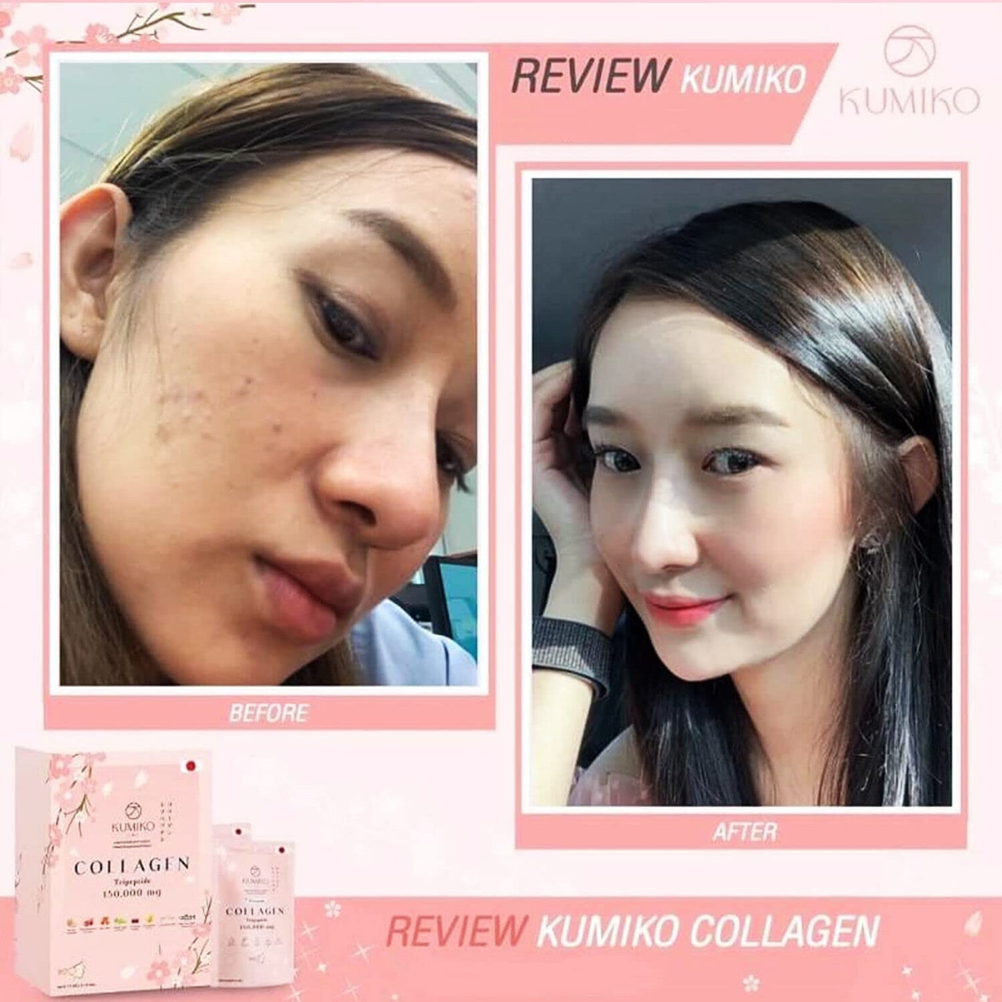 KUMIKO Collagen Tripeptide 150000mg Radiant Skin Natural Healthy Collagen Women Skin Care Nourishment Acne Blemishes Reduction Heals Dark Spot Organic Extract Supplement