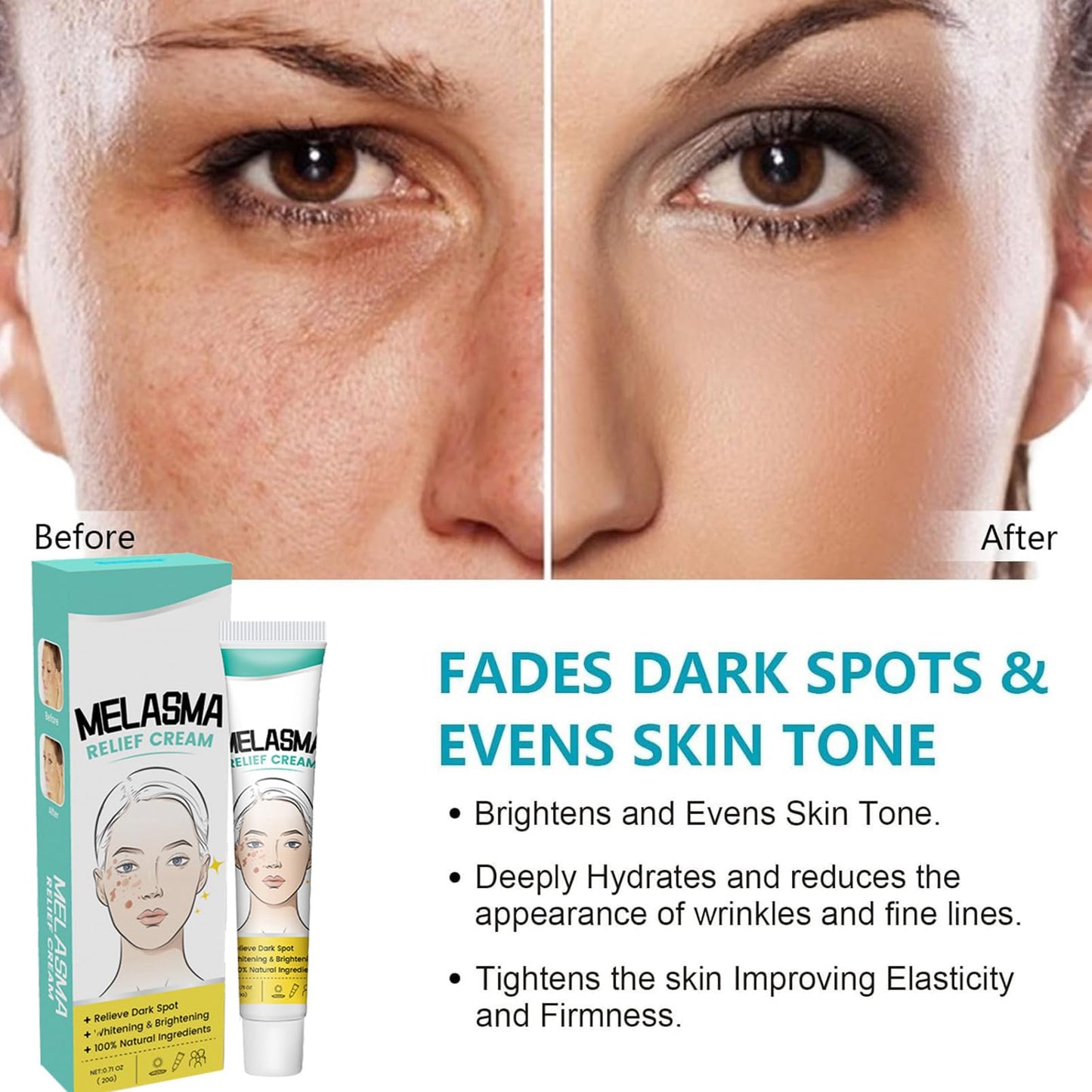 MEITREND Melasma Treatment For Face,Dark Spot Remover for Face & Body, Pigmentation Removal Cream,Corrector For Age Spots Sun Spots Freckles Melasma Brown Spots,Freckle Removal Cream