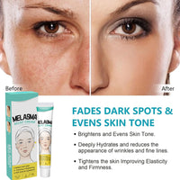 MEITREND Melasma Treatment For Face,Dark Spot Remover for Face & Body, Pigmentation Removal Cream,Corrector For Age Spots Sun Spots Freckles Melasma Brown Spots,Freckle Removal Cream