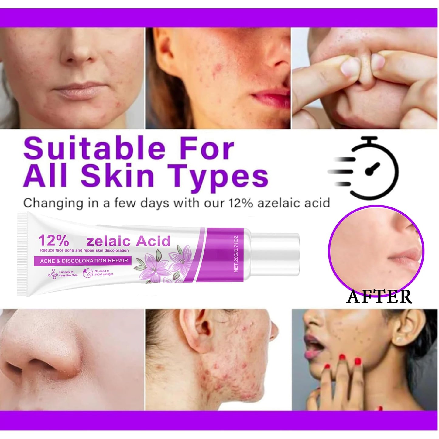 MEITREND Acid 12% Facial Serum,2PCS Rosacea Treatment for Face,Anti Acne Cream for Women & Men,Anti Redness Cream for Face,Reduce Acne & Removes Redness,Skin Care Gel