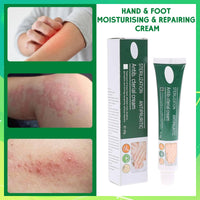 Athlete's foot Treatment cream - anti fungal foot cream for dry Feet, cracked heel Treatment & Athletes foot cream extra strong