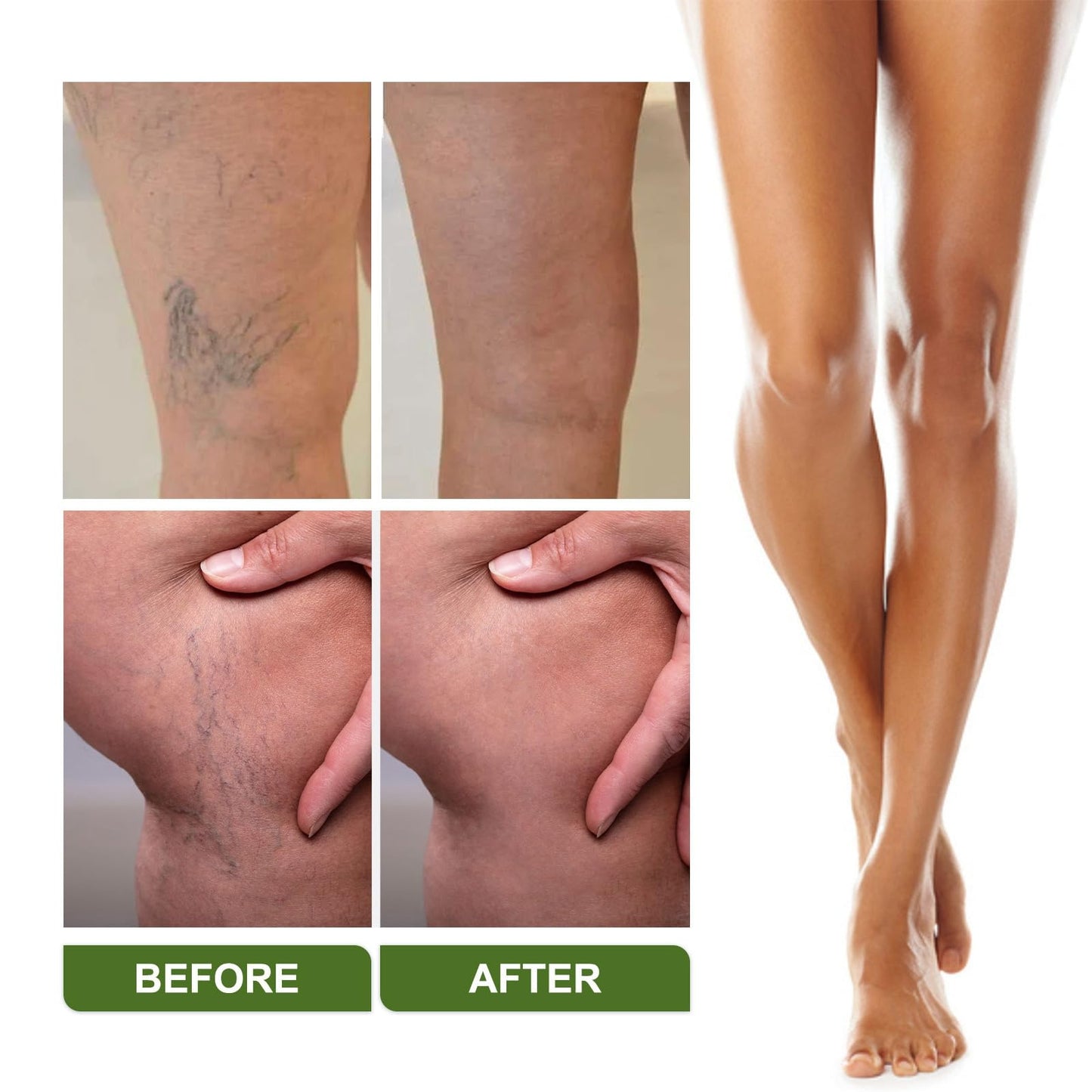 Varic/ose Ve/ins Treatment for Legs,Natural Varic/ose Ve/ins Cream,Varic/ose Ve/ins Treatment Cream,Cream for Varic/ose Ve/ins in Legs,SPI/der V/eins Repair Cream,Varic/ose Ve/ins Relief Cream